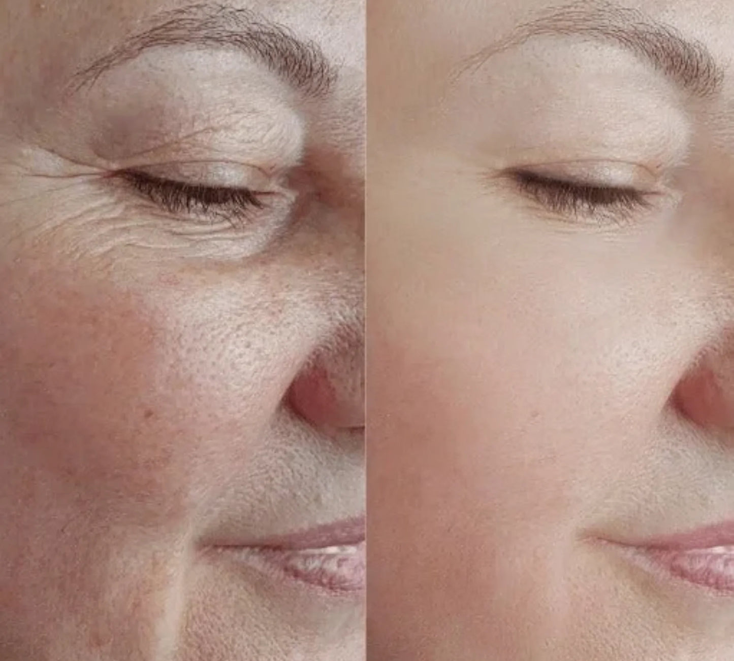 BioLift™ - Stödjer hudens naturliga återhämtning – för färre linjer och mer fasthet, på ett skonsamt sätt.