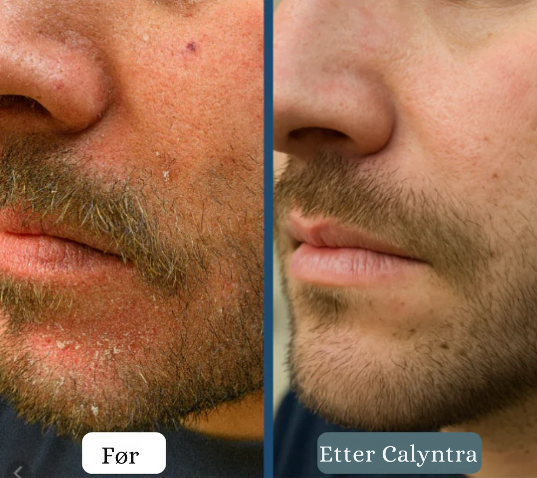 Calyntra™ – Den milda lösningen mot bestående rodnad, klåda och mjäll