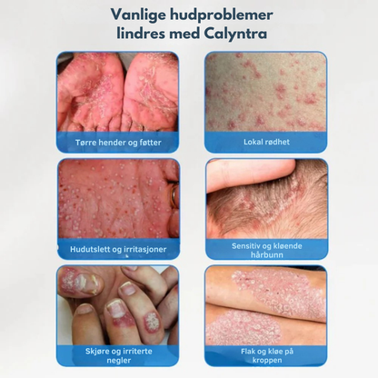 Calyntra™ – Den milda lösningen mot bestående rodnad, klåda och mjäll